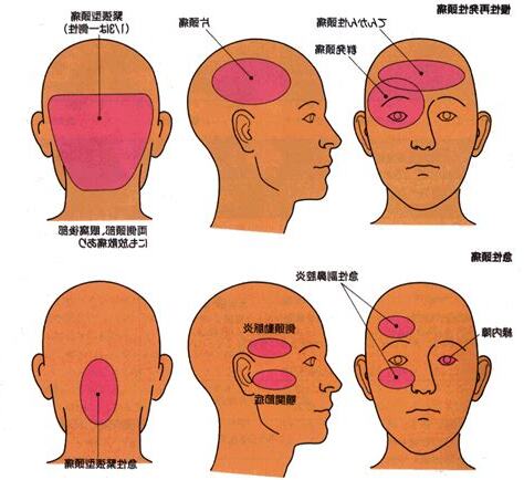 頭痛 位置